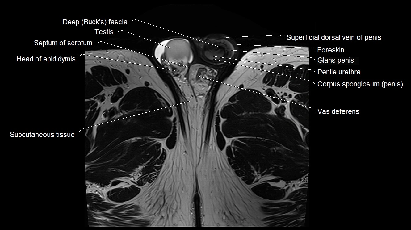 MRI 3T scrotum and penis axial cross sectional anatomy image 29.webp